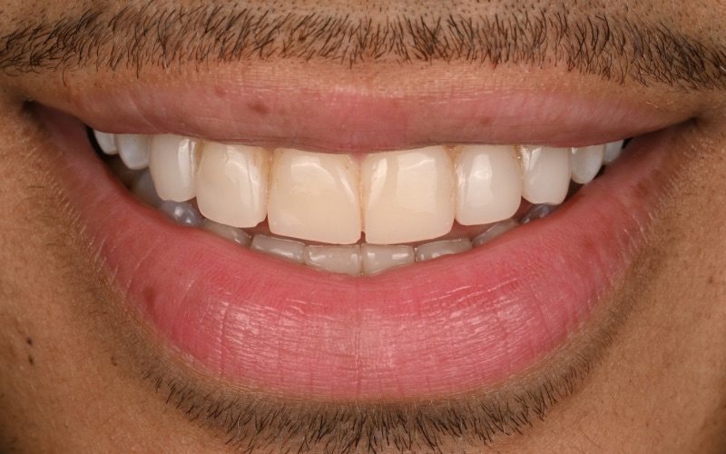 Before