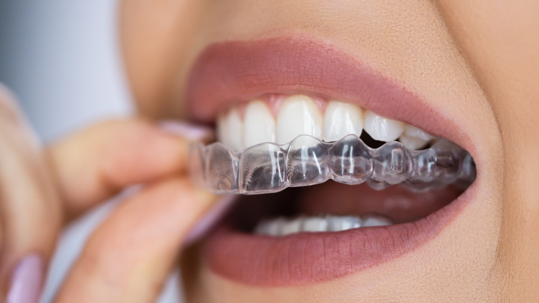 Comparing cosmetic dental options