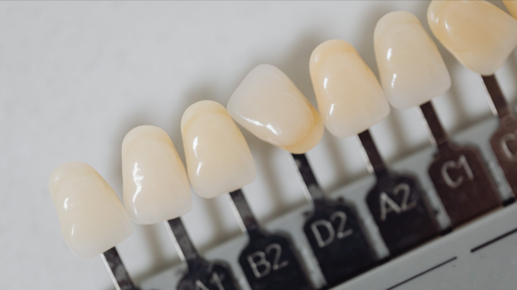 Natural-looking porcelain veneers
