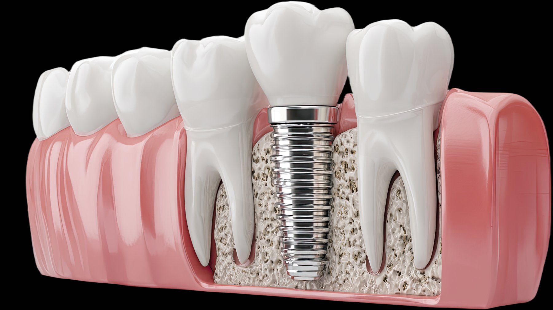 Dental implants by Dr Aodhan Docherty