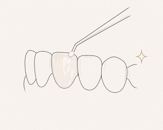 Composite bonding