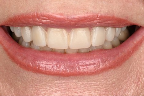 Case 13 after