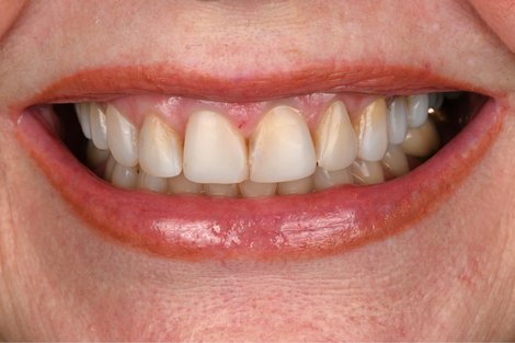 Case 13 before